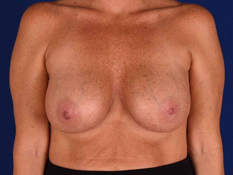 Breast Surgery Revision Before & After Gallery - Patient 18241879 - Image 2