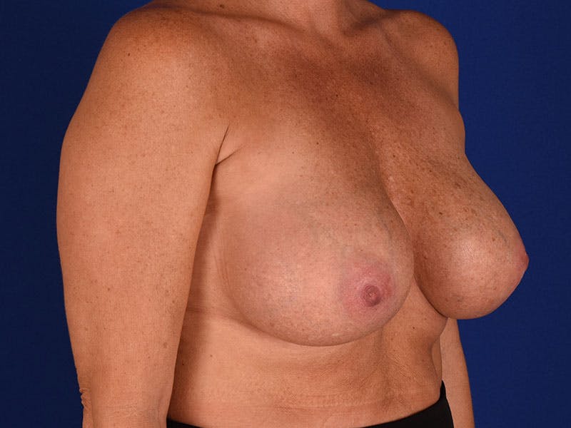 Breast Surgery Revision Before & After Gallery - Patient 18241879 - Image 4