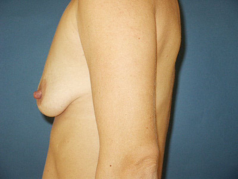 Breast Lift With Augmentation Before & After Gallery - Patient 18241878 - Image 5