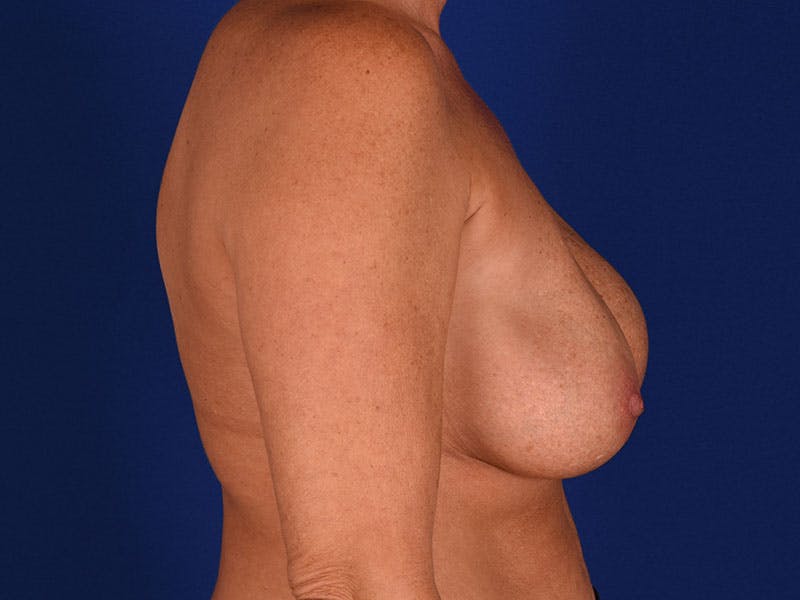 Breast Surgery Revision Before & After Gallery - Patient 18241879 - Image 5