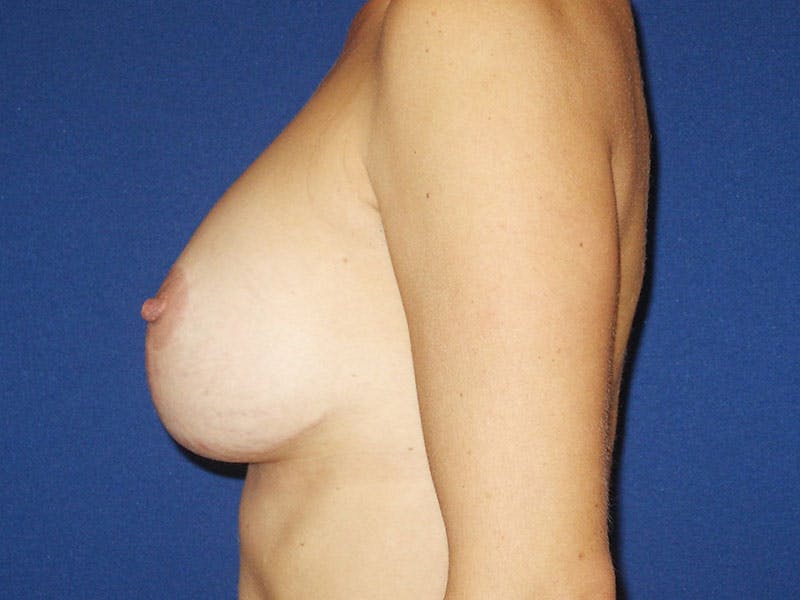 Breast Lift With Augmentation Before & After Gallery - Patient 18241878 - Image 6
