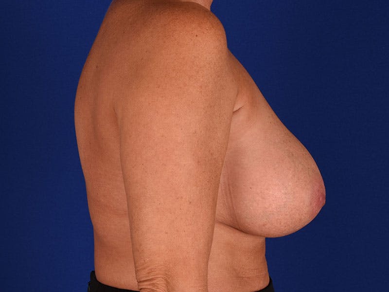 Breast Surgery Revision Before & After Gallery - Patient 18241879 - Image 6