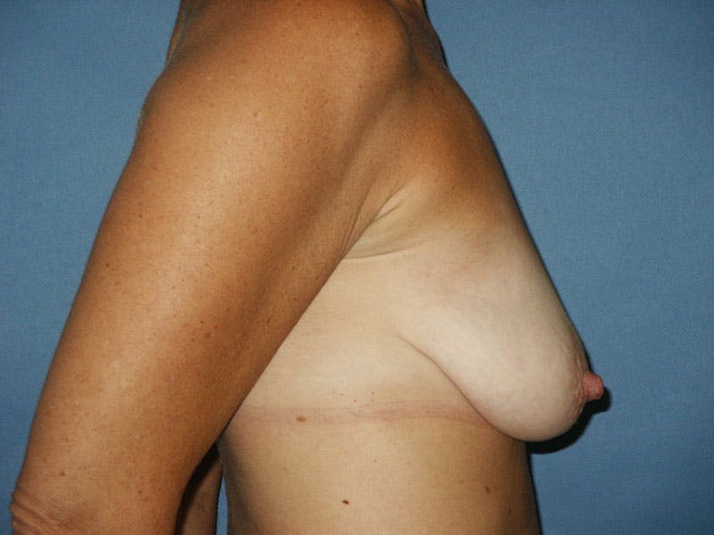 Breast Lift With Augmentation Before & After Gallery - Patient 18241892 - Image 5