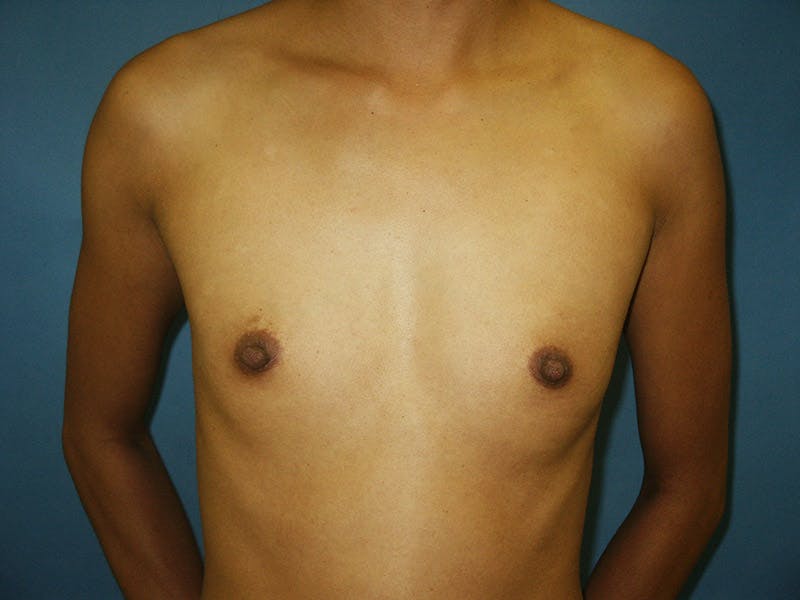 Breast Augmentation Before & After Gallery - Patient 18241894 - Image 1