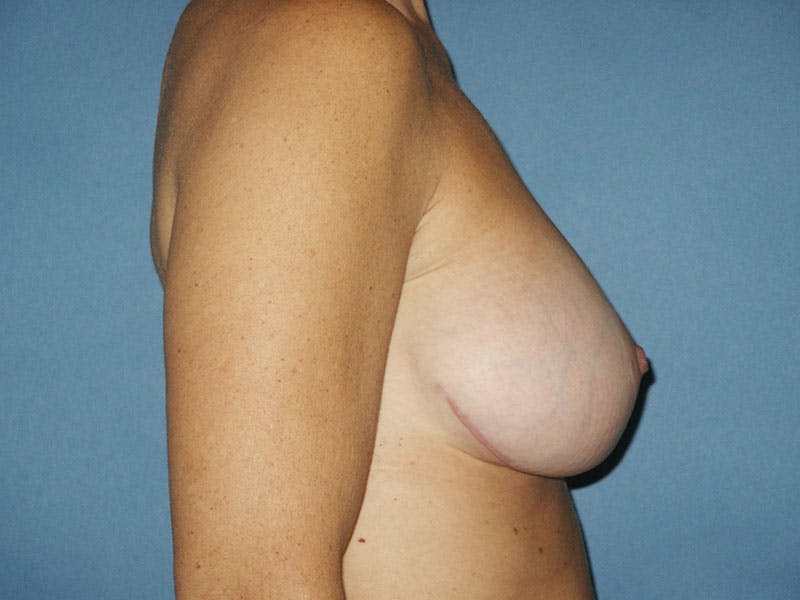 Breast Lift With Augmentation Before & After Gallery - Patient 18241892 - Image 6