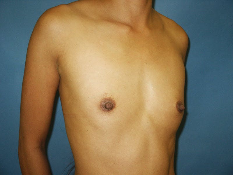 Breast Augmentation Before & After Gallery - Patient 18241894 - Image 3
