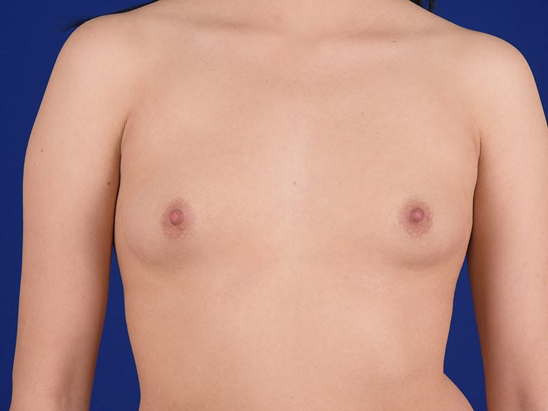 Breast Augmentation Before & After Gallery - Patient 18241909 - Image 1