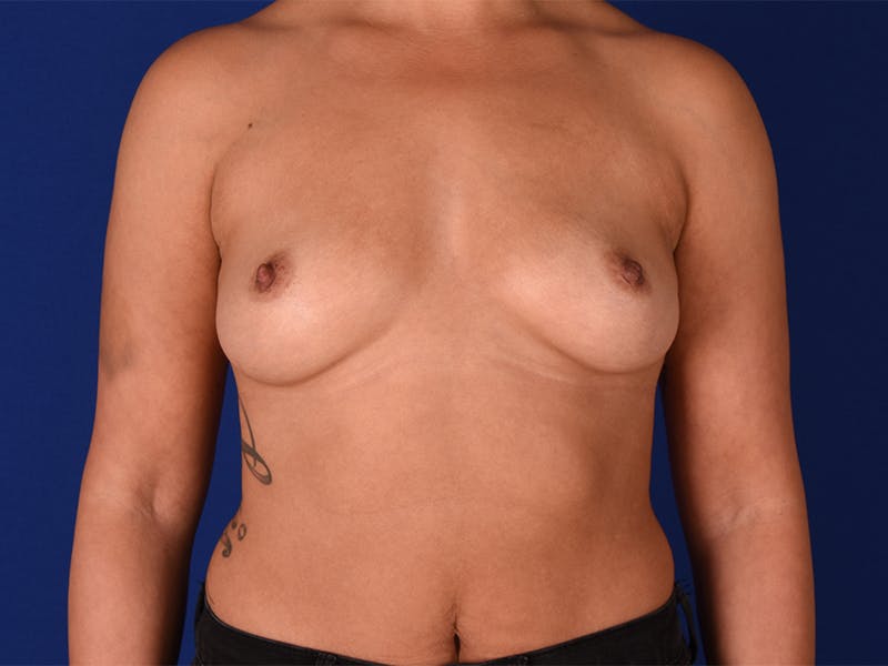 Breast Augmentation Before & After Gallery - Patient 18241920 - Image 1