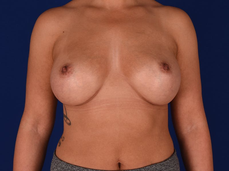 Breast Augmentation Before & After Gallery - Patient 18241920 - Image 2