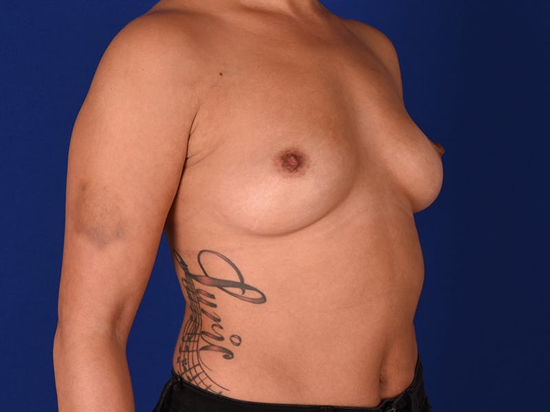 Breast Augmentation Before & After Gallery - Patient 18241920 - Image 3