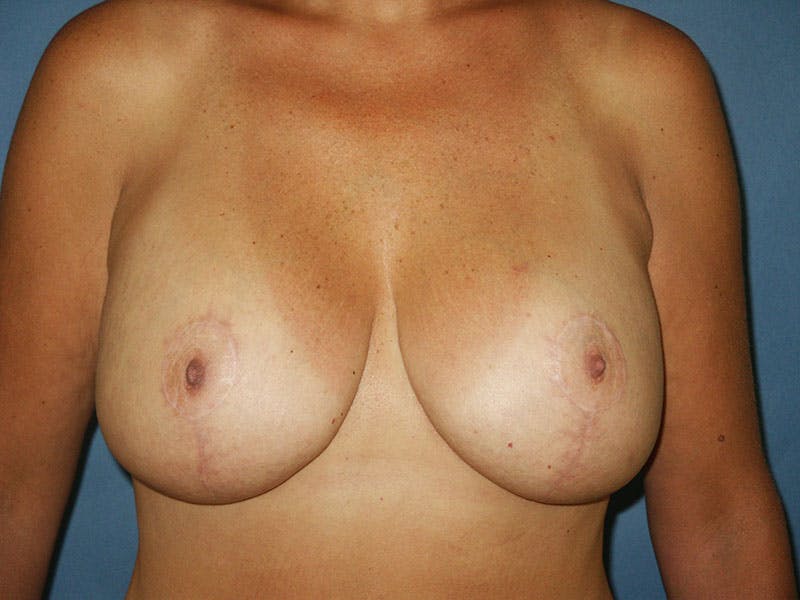Breast Lift With Augmentation Before & After Gallery - Patient 18241925 - Image 2