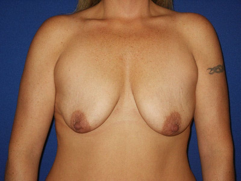 Breast Lift With Augmentation Before & After Gallery - Patient 18241935 - Image 1