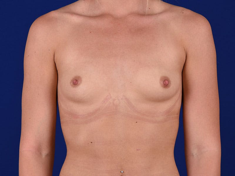 Breast Augmentation Before & After Gallery - Patient 18241940 - Image 1