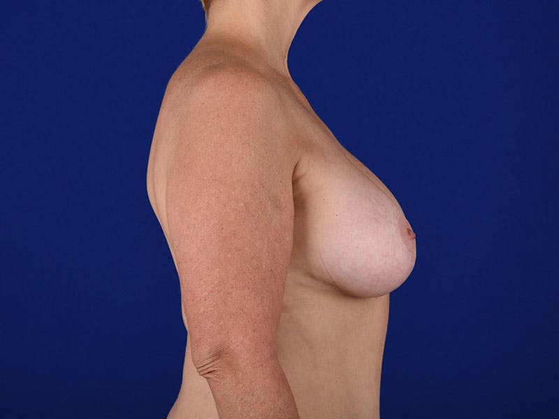Breast Lift With Augmentation Before & After Gallery - Patient 18241938 - Image 6