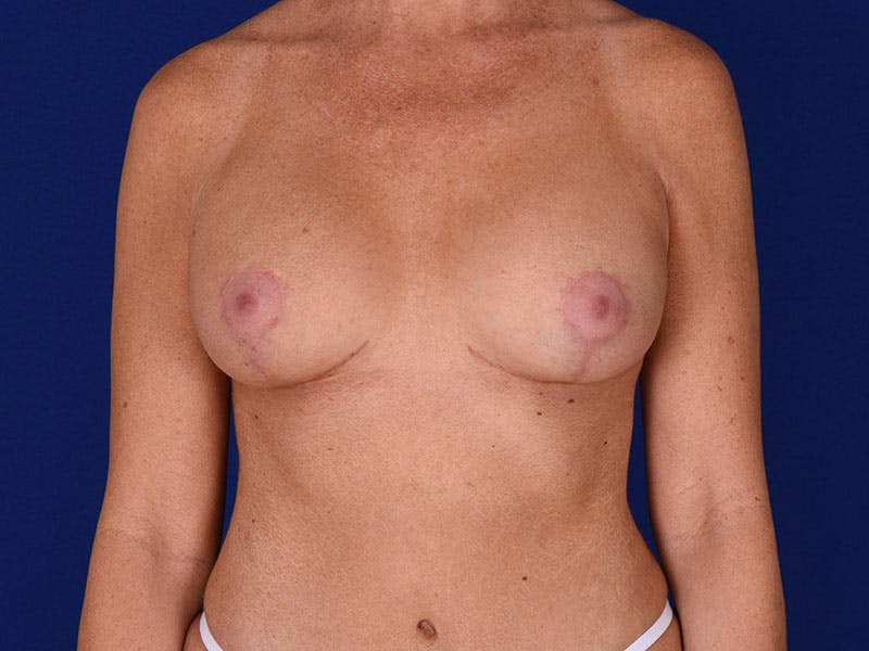 Breast Lift With Augmentation Before & After Gallery - Patient 18241944 - Image 2