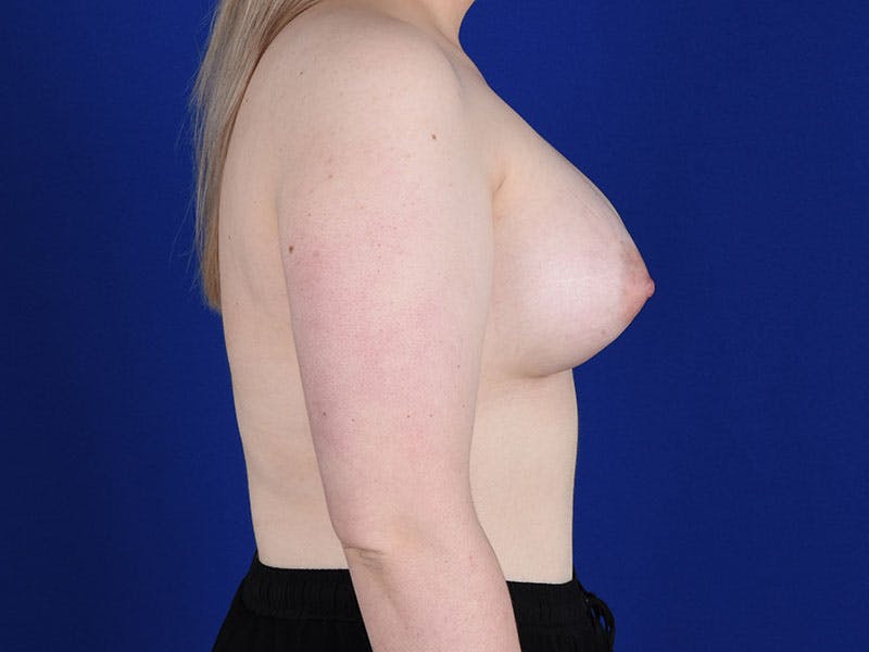 Breast Lift With Augmentation Before & After Gallery - Patient 18241964 - Image 6