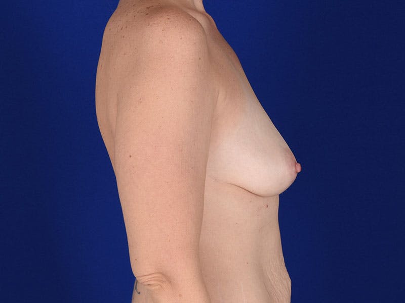 Breast Augmentation Before & After Gallery - Patient 18241965 - Image 5