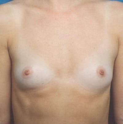 Breast Augmentation Before & After Gallery - Patient 18241968 - Image 1