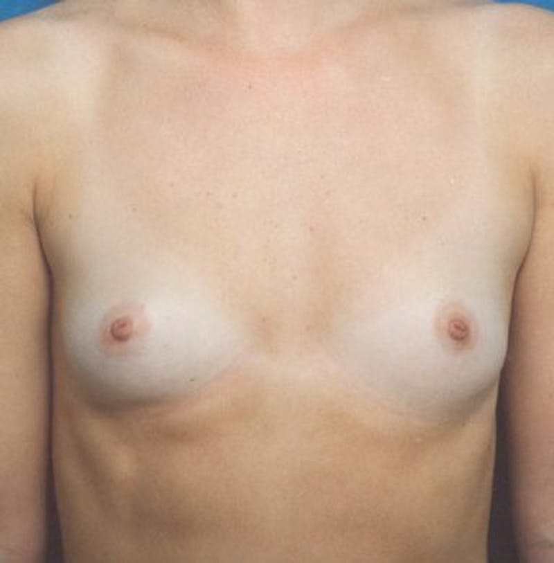 Breast Augmentation Before & After Gallery - Patient 18241968 - Image 1
