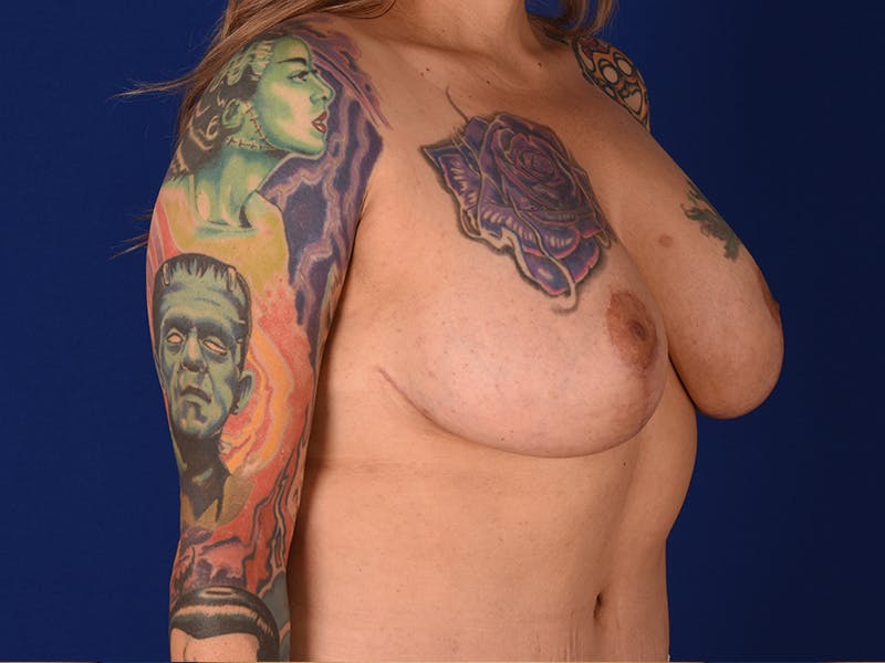 Breast Lift With Augmentation Before & After Gallery - Patient 18241977 - Image 4
