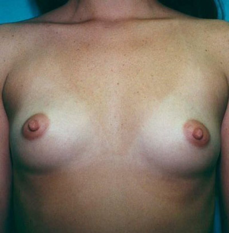 Breast Augmentation Before & After Gallery - Patient 18241980 - Image 1