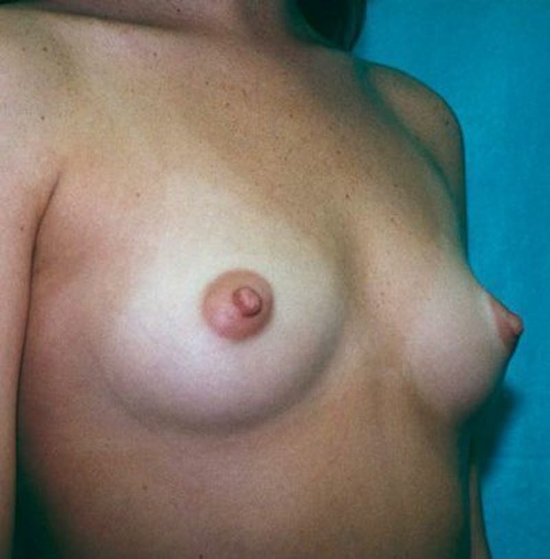 Breast Augmentation Before & After Gallery - Patient 18241980 - Image 3