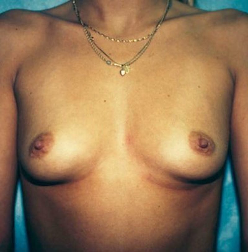 Breast Augmentation Before & After Gallery - Patient 18241986 - Image 1