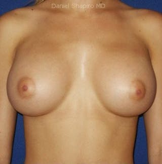 Breast Augmentation Before & After Gallery - Patient 18241991 - Image 2