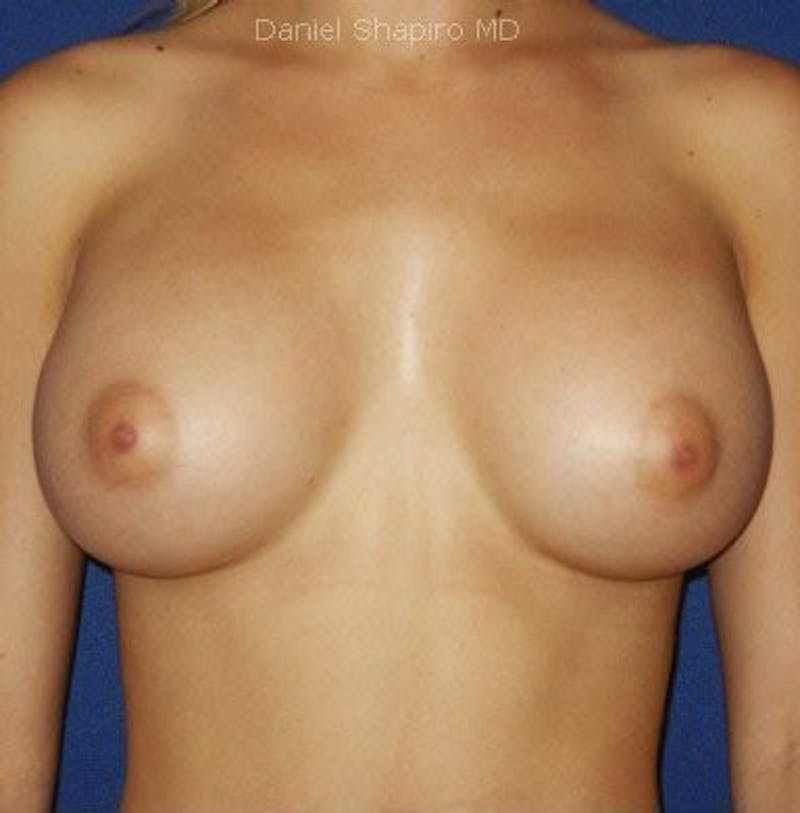 Breast Augmentation Before & After Gallery - Patient 18241991 - Image 2