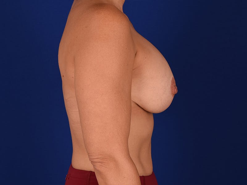 Breast Surgery Revision Before & After Gallery - Patient 18241994 - Image 5