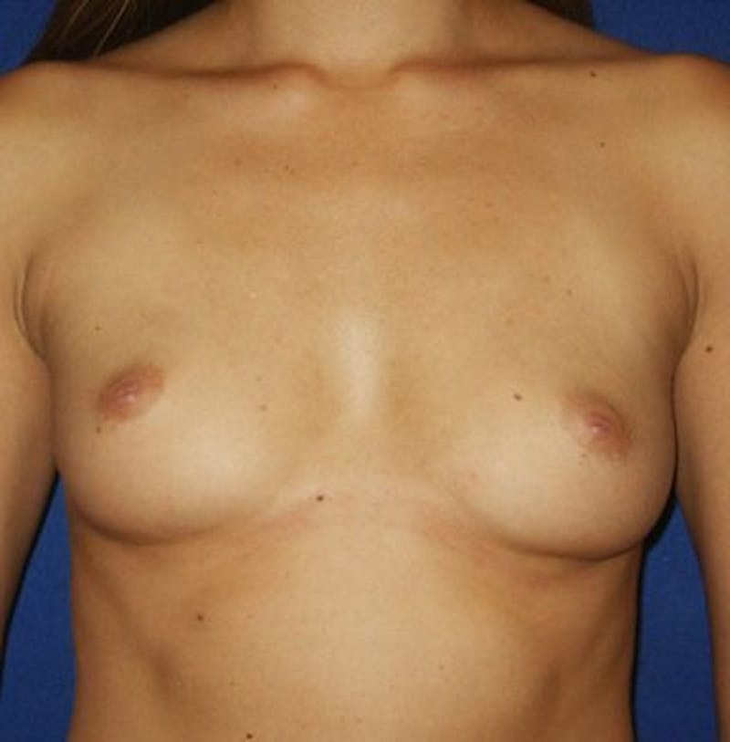 Breast Augmentation Before & After Gallery - Patient 18241995 - Image 1