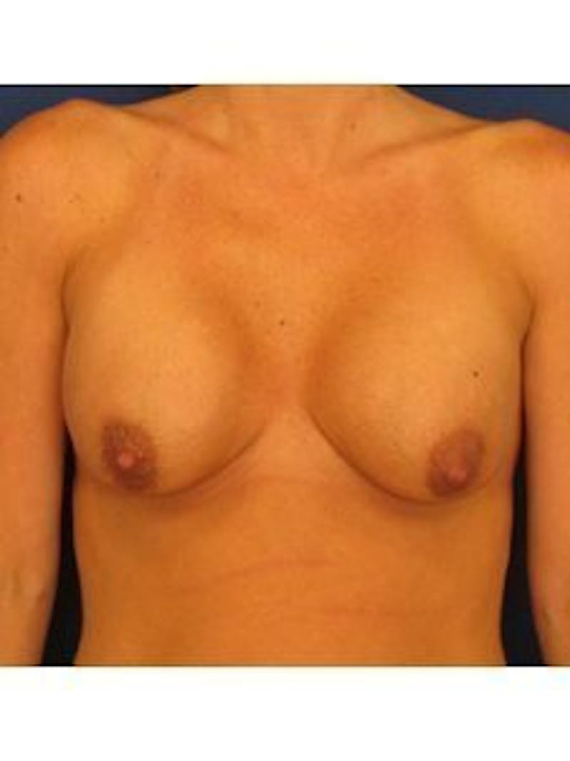 Breast Surgery Revision Before & After Gallery - Patient 18241996 - Image 1
