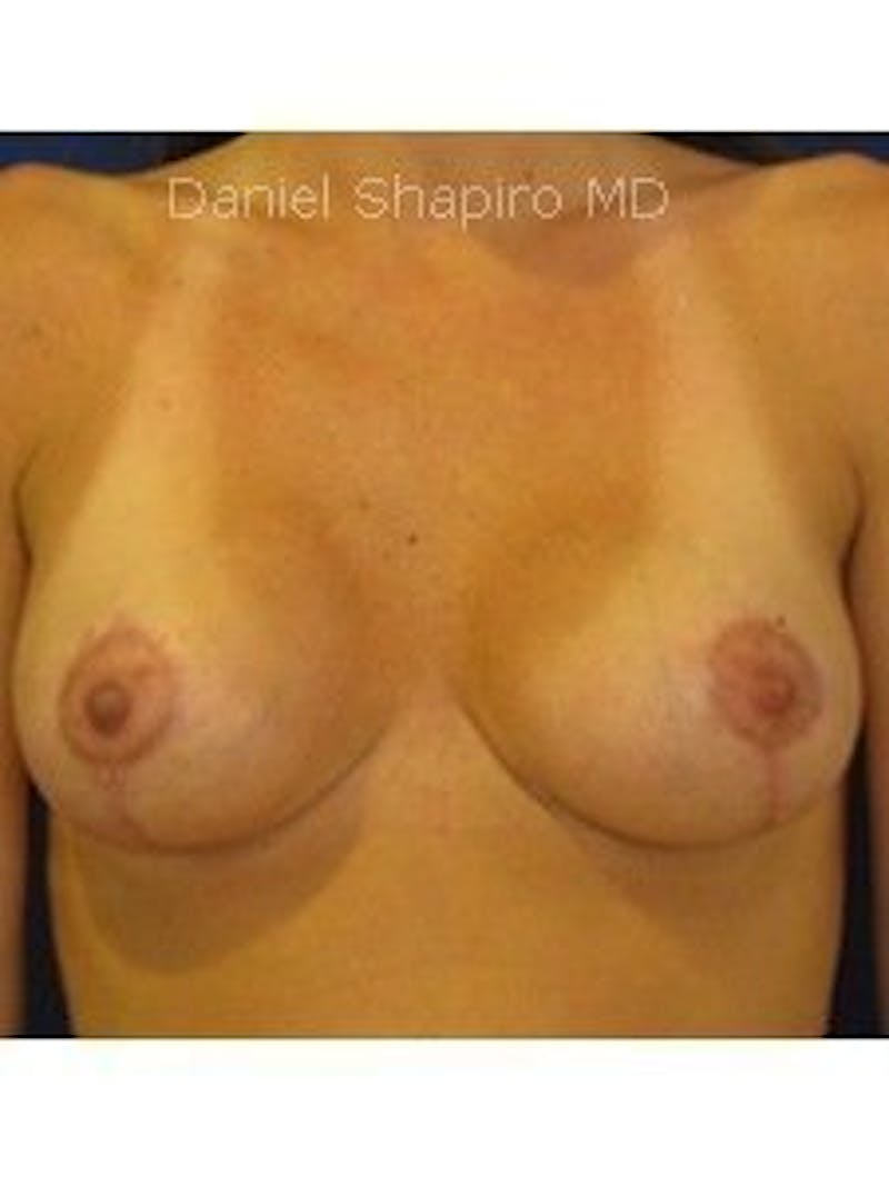Breast Surgery Revision Before & After Gallery - Patient 18241996 - Image 2