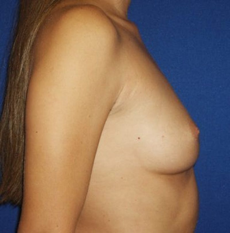 Breast Augmentation Before & After Gallery - Patient 18241995 - Image 5