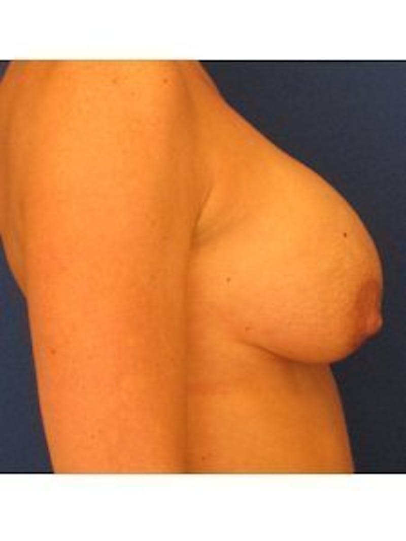 Breast Surgery Revision Before & After Gallery - Patient 18241996 - Image 3