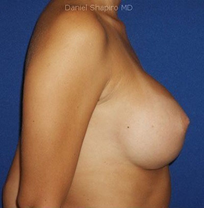 Breast Augmentation Before & After Gallery - Patient 18241995 - Image 6
