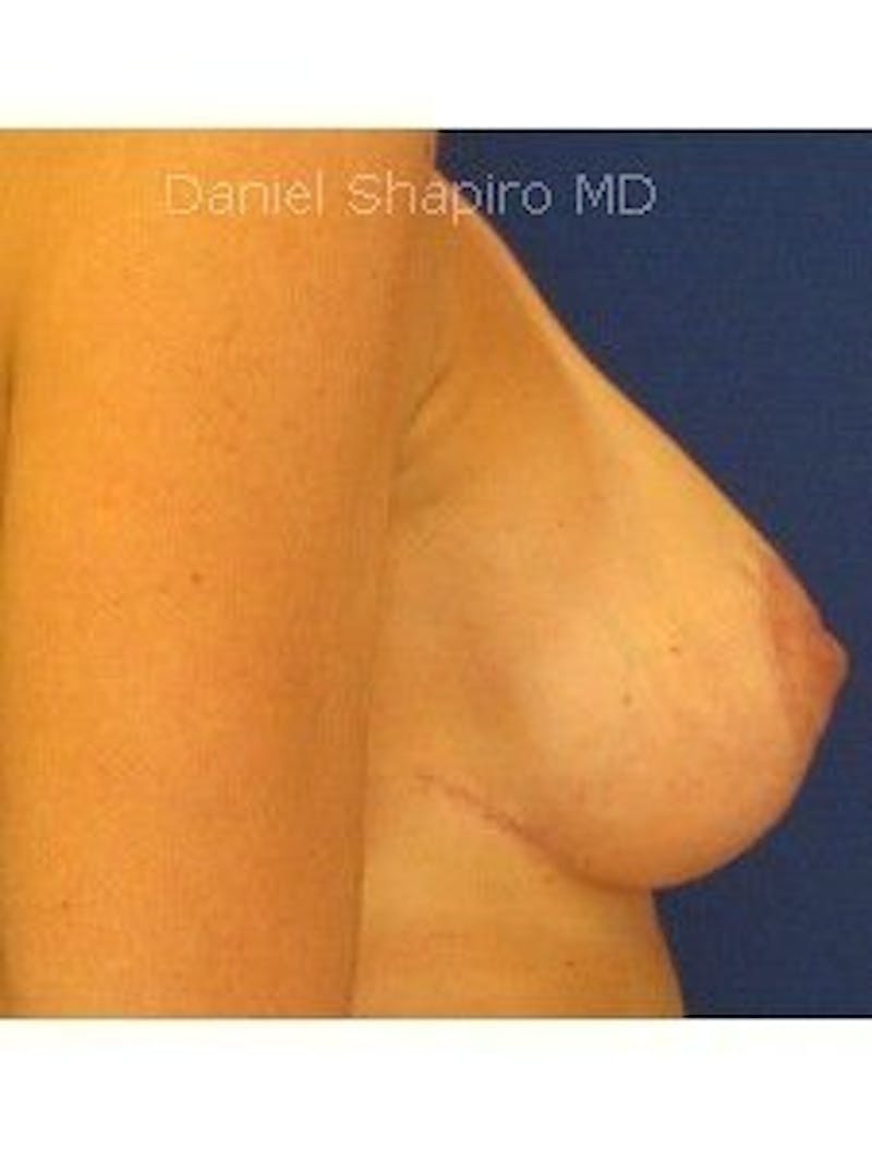 Breast Surgery Revision Before & After Gallery - Patient 18241996 - Image 4