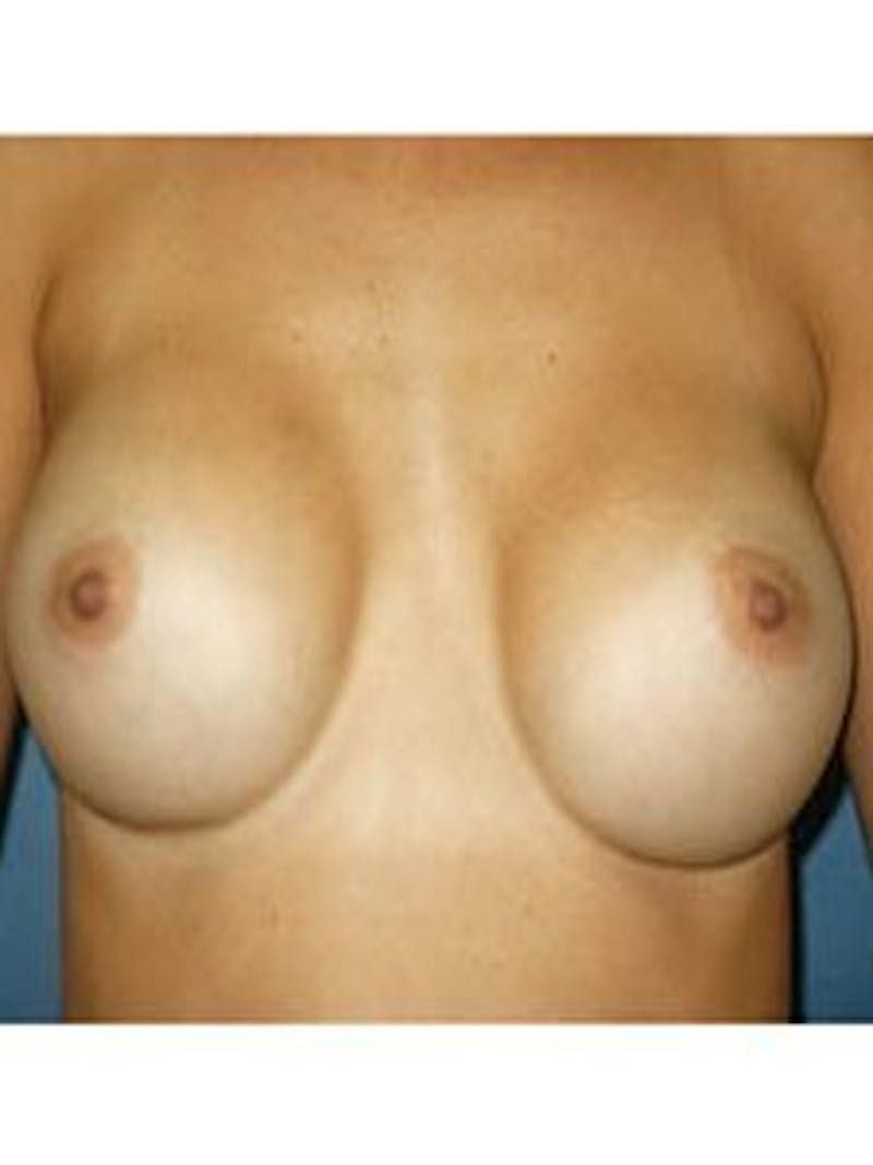 Breast Surgery Revision Before & After Gallery - Patient 18241998 - Image 1