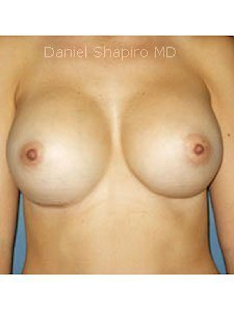 Breast Surgery Revision Before & After Gallery - Patient 18241998 - Image 2
