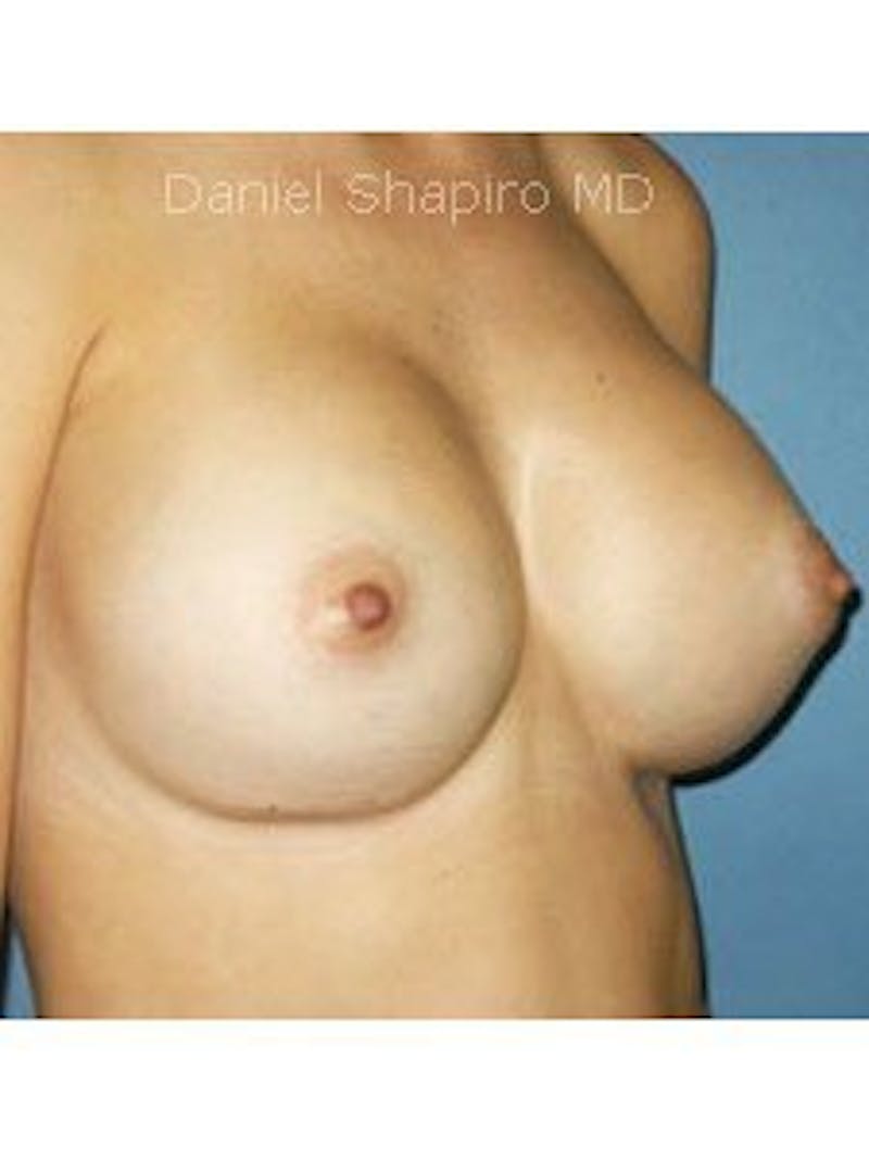 Breast Surgery Revision Before & After Gallery - Patient 18241998 - Image 4
