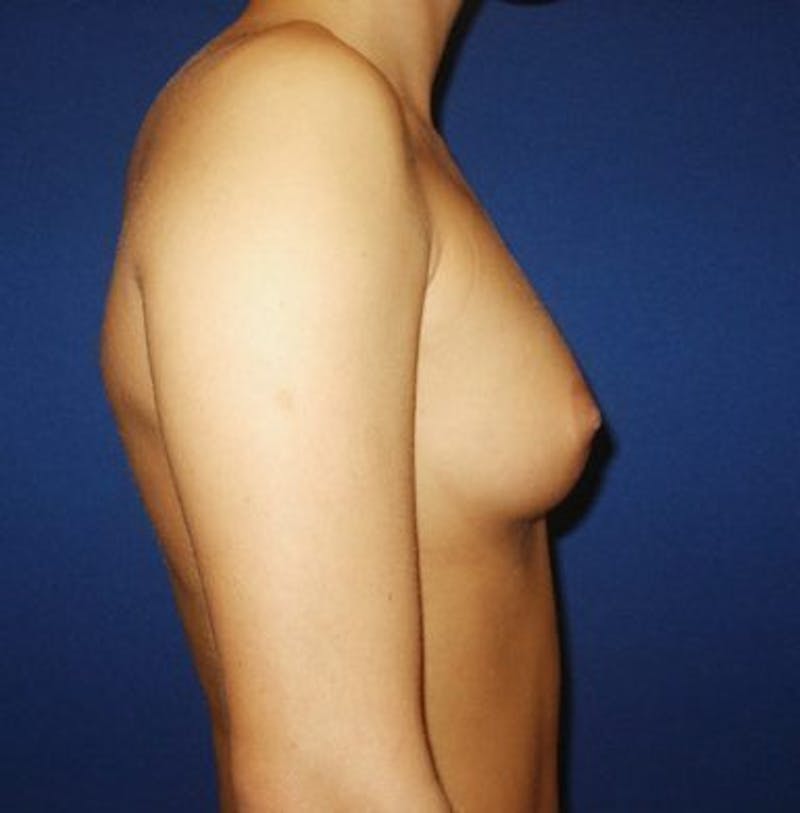 Breast Augmentation Before & After Gallery - Patient 18241999 - Image 5