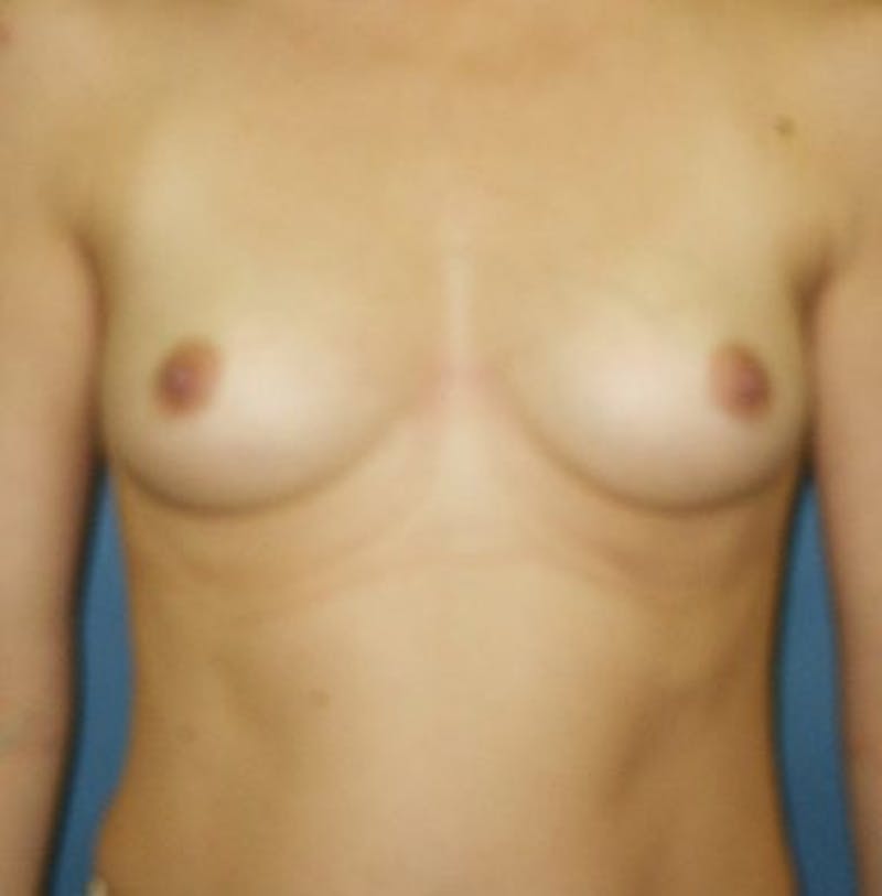 Breast Augmentation Before & After Gallery - Patient 18242003 - Image 1