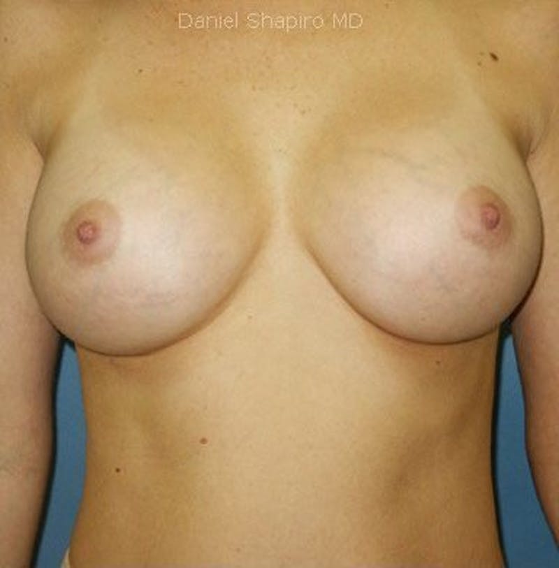 Breast Augmentation Before & After Gallery - Patient 18242003 - Image 2