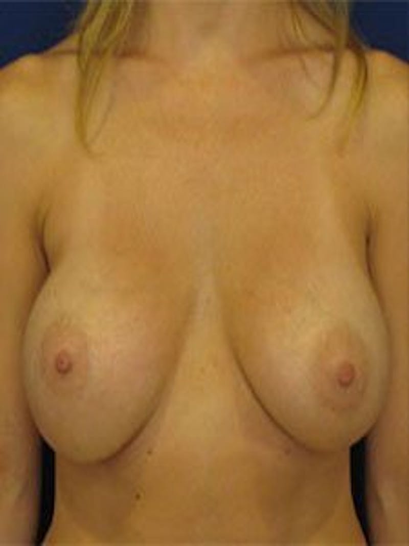 Breast Surgery Revision Before & After Gallery - Patient 18242002 - Image 1