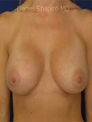 Breast Surgery Revision Before & After Gallery - Patient 18242002 - Image 2