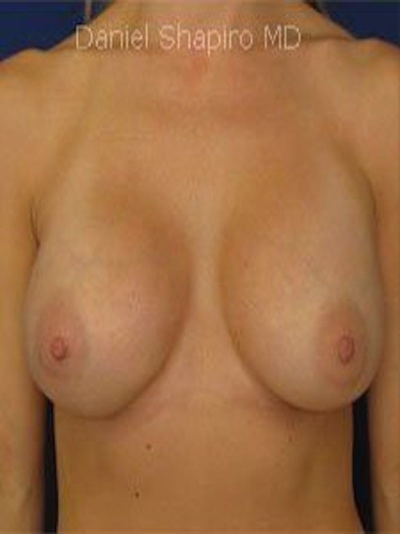 Breast Surgery Revision Before & After Gallery - Patient 18242002 - Image 2