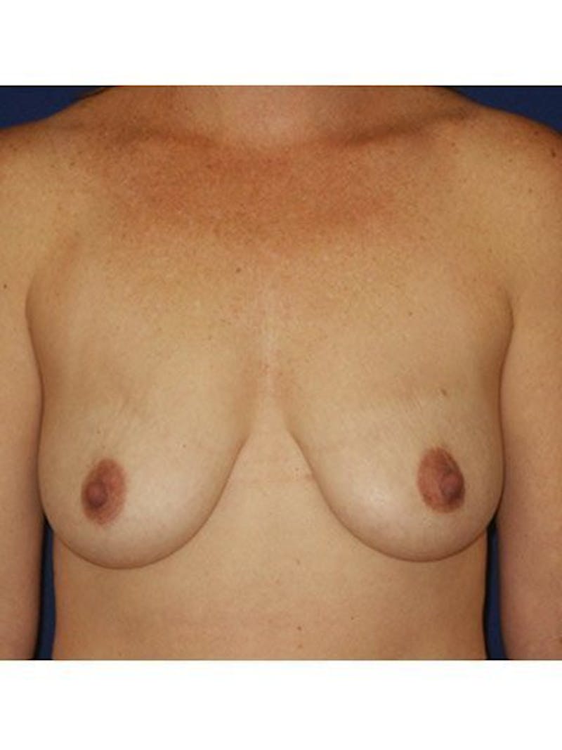 Breast Lift With Augmentation Before & After Gallery - Patient 18242005 - Image 1