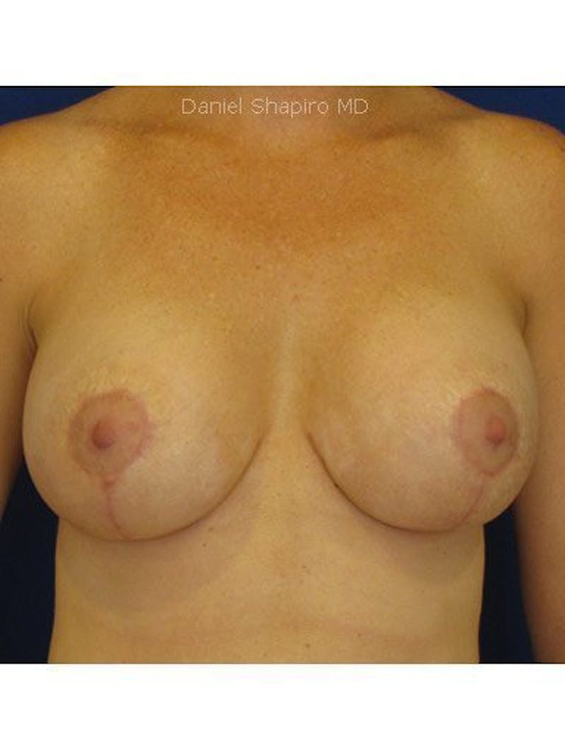 Breast Lift With Augmentation Before & After Gallery - Patient 18242005 - Image 2