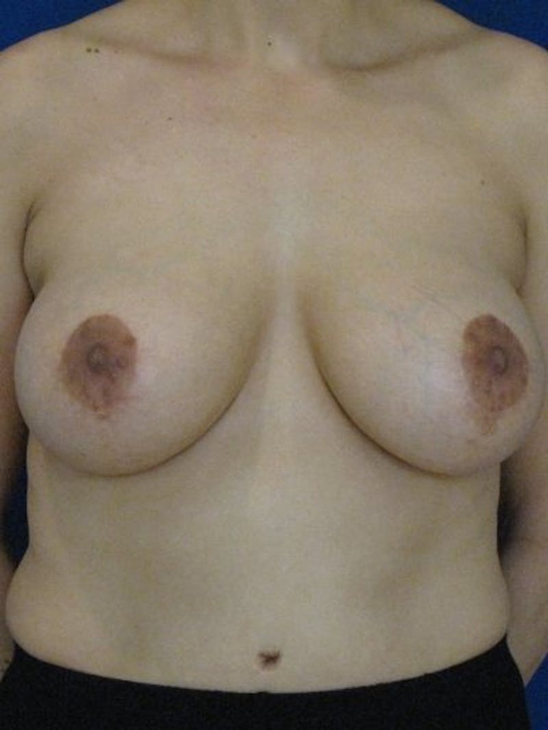 Breast Surgery Revision Before & After Gallery - Patient 18242006 - Image 1