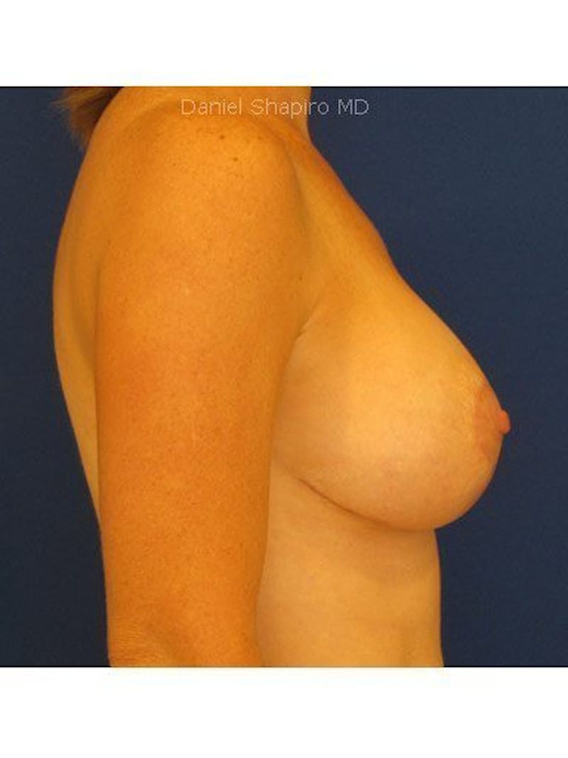 Breast Lift With Augmentation Before & After Gallery - Patient 18242005 - Image 4